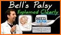 Bell’s Palsy related image