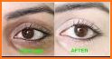 Get Rid Of Dark Circles Under Eyes related image