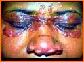 Sarcoidosis Disease related image