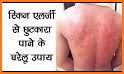 Home Remedies For Skin Allergy related image