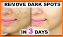 Acne Scar Removal Tips and Tricks related image