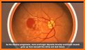 Macular Degeneration (AMD) related image