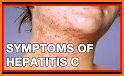 Hepatitis C: Causes, Diagnosis, and Treatment related image