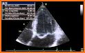 HEART EJECTION FRACTION: HOW TO EYEBALL THE EF related image