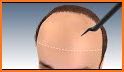 Hair Transplant Simulation related image