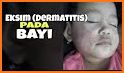 tips simpel cara menghilangkan bentol pada bayi related image