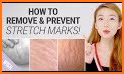 Get Rid Of Stretch Marks Naturally related image