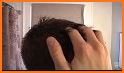 Get Rid of Dandruff related image