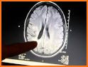 Understanding MRI: Multiple Sclerosis related image