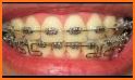 Braces Photo Editor 2020 related image