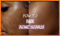 Acne Scar Removal Tips and Tricks related image