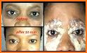 Get Rid Of Dark Circles Under Eyes related image