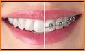 Braces Photo Editor related image